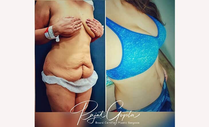 How to Choose the Correct CCs for Your Implant - Dr Rajat Gupta - Plastic Surgeon in Delhi -RG Aesthetics 03 Breast implant before and after