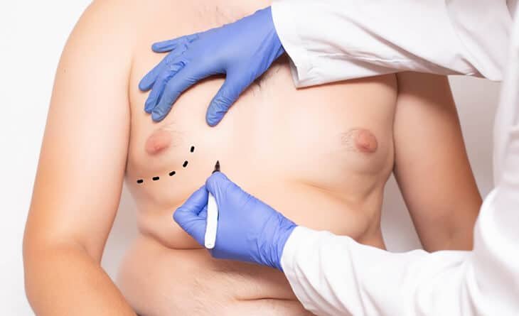 How to Get Gynecomastia Surgery Covered by Insurance - Dr Rajat Gupta - Cosmetic Plastic Surgeon - RG Aesthetics -01 Gynecomastia surgery