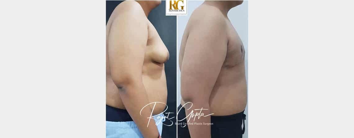 Say Goodbye to Male Breast Enlargement with the OCCULT Technique - Dr Rajat Gupta Say Goodbye to Male Breast Enlargement with the OCCULT Technique - Dr Rajat Gupta