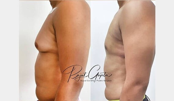 Scar-Free Gynecomastia Surgery in Delhi - Dr Rajat Gupta Scar-Free Gynecomastia Surgery in Delhi - Dr Rajat Gupta