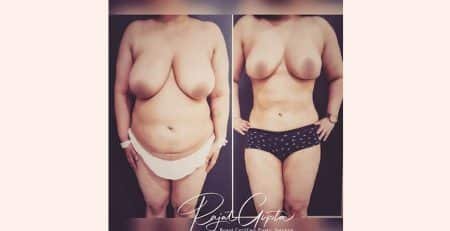 Liposuction surgery before and after