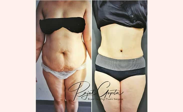 Should I Get Tummy Tuck or Liposuction for Loose Skin - Dr Rajat Gupta - Plastic Surgeon in Delhi -RG Aesthetics 02 Tummy tuck surgery before and after