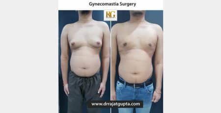 gynecomastia surgery before and after