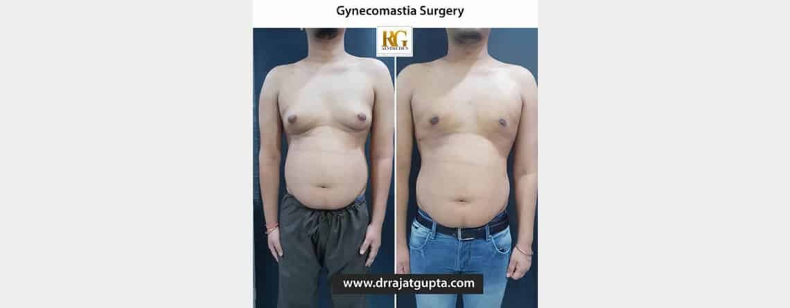 gynecomastia surgery before and after