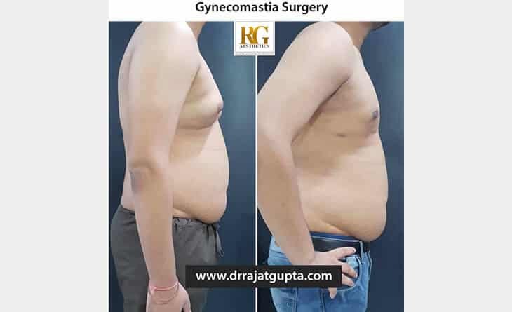 The Ultimate Guide to Scarless Gynecomastia Surgery in Delhi by Dr Rajat Gupta - RG Aesthetics -02 scarless gynecomastia surgery Delhi