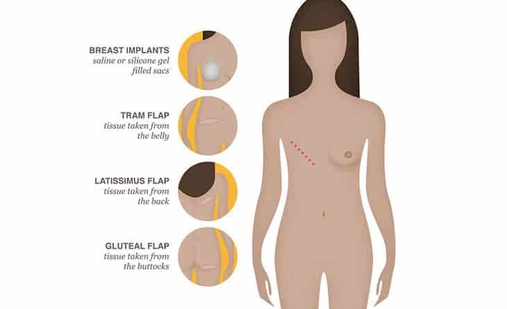 What Are My Breast Reconstruction Surgery Options - Dr Rajat Gupta - RG Aesthetics -02 Breast Reconstruction Surgery