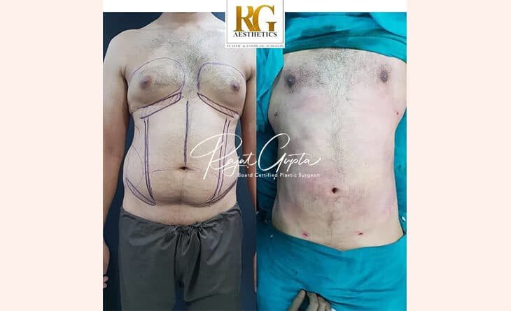 Dr Rajat Gupta Pioneers Scarless Gynecomastia Surgery in India - RG Aesthetics -02 Gynecomastia Surgery before and after results