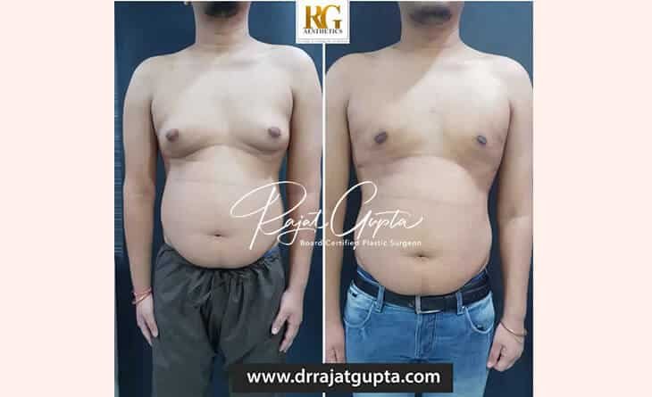 Gynecomastia surgery recovery Delhi - Dr Rajat Gupta - RG Aesthetics -01 gynecomastia surgery before and after
