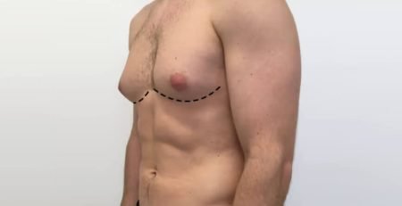 gynecomastia surgery recovery Delhi