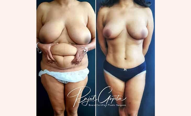 High-Definition Abdominoplasty by Dr Rajat Gupta in Delhi - SHARP Technique -02 high definition abdominoplasty results