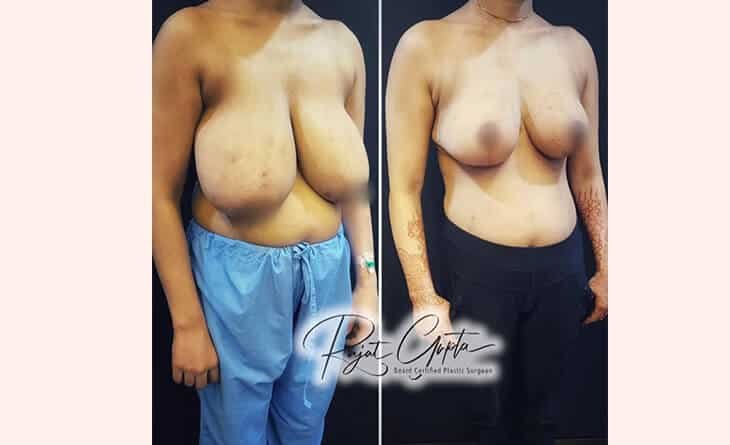 Ideal Candidates for RG Flap Breast Reduction - Dr Rajat Gupta - Best Breast Reduction surgeon in Delhi - RG Aesthetics -04 breast reduction surgery before and after