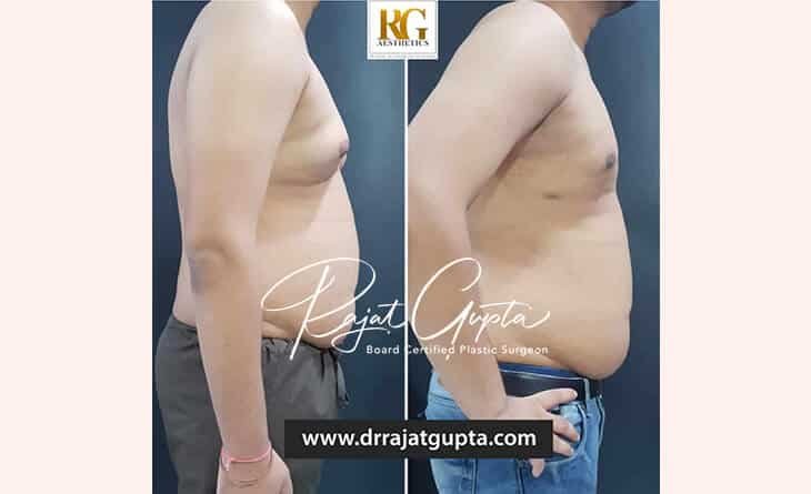 OCCULT Technique Ideal for Grade II–III Gynecomastia - Dr Rajat Gupta - Best Gynecomastia Surgeon in Delhi NCR - RG Aesthetics -01 gynecomastia surgery before and after