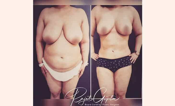 RG Flap Technique Creates a Natural Lift Without Implants - Dr Rajat Gupta- Best breast reduction surgeon in Delhi - RG Aesthetics breast reduction surgery before and after