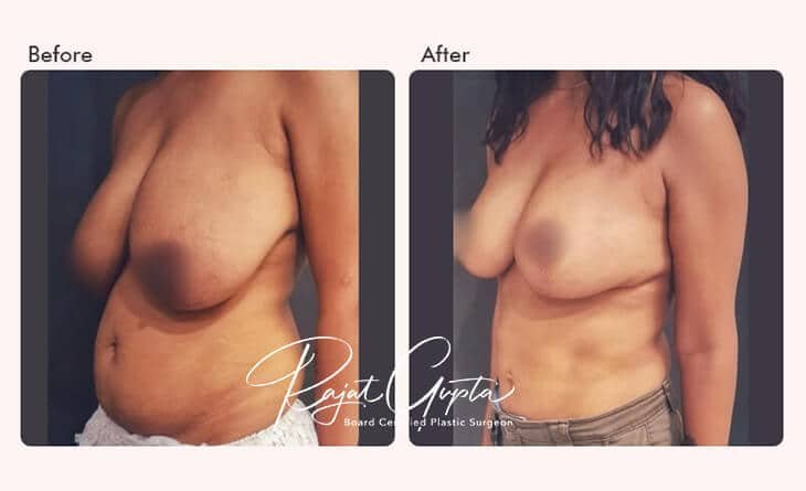 RG flap breast reduction in Delhi - Dr Rajat Gupta - Cosmetic Plastic Surgeon in Delhi - RG Aesthetics -02 RG flap breast reduction Delhi