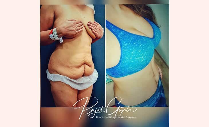 Breast Augmentation- Implants or Fat Transfer - Dr Rajat Gupta - RG Aesthetics -02 Breast Augmentation before and after