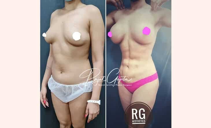 Liposuction Surgery Cost in Delhi - Best Liposuction Surgeon in India - Dr Rajat Gupta Liposuction Surgery before and after
