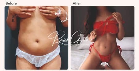 Liposuction Surgery Before and After