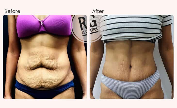 Liposuction Surgery Cost in Delhi - Liposuction Surgery Before and After - Dr Rajat Gupta - Plastic Surgeon in Delhi - RG Aesthetics Liposuction Surgery Cost in Delhi