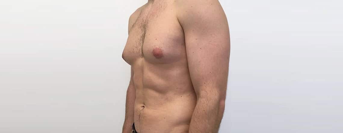 Gynecomastia Surgery