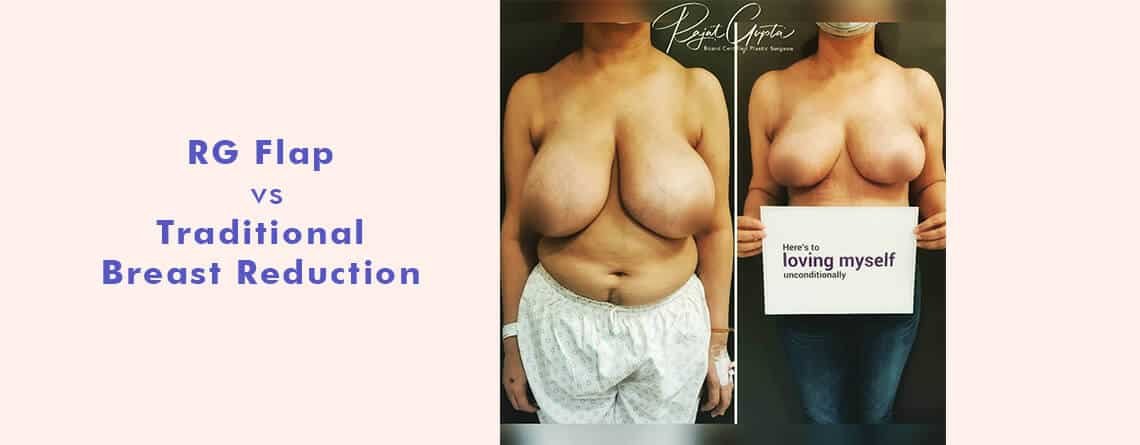 RG flap vs traditional breast reduction