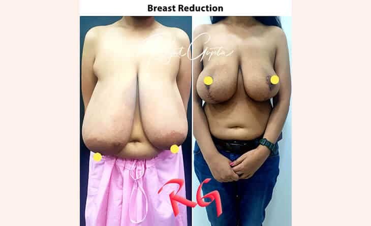 RG Flap vs Traditional Breast Reduction - Dr Rajat Gupta Plastic Surgeon - RG Aesthetics -02 breast reduction surgery before and after