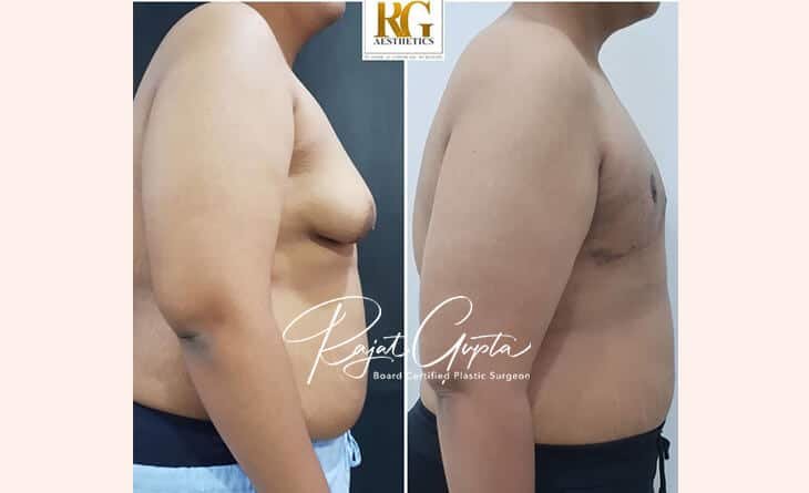 Scarless Gynecomastia Surgery Possible in India - Gynecomastia Surgery Before and After - Dr Rajat Gupta - Plastic Surgeon in Delhi Gynecomastia Surgery Before and After Result