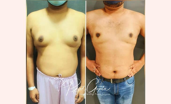male breast reduction surgery cost - gynecomastia surgery cost in delhi - Dr rajat gupta - RG aesthetics Gynecomastia Surgery before and after