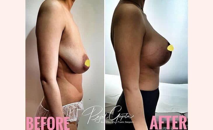 Breast Lift Before After Results - Dr Rajat Gupta - Breast lift surgery cost in delhi - RG Aesthetics -01 Breast Lift Surgery before and after