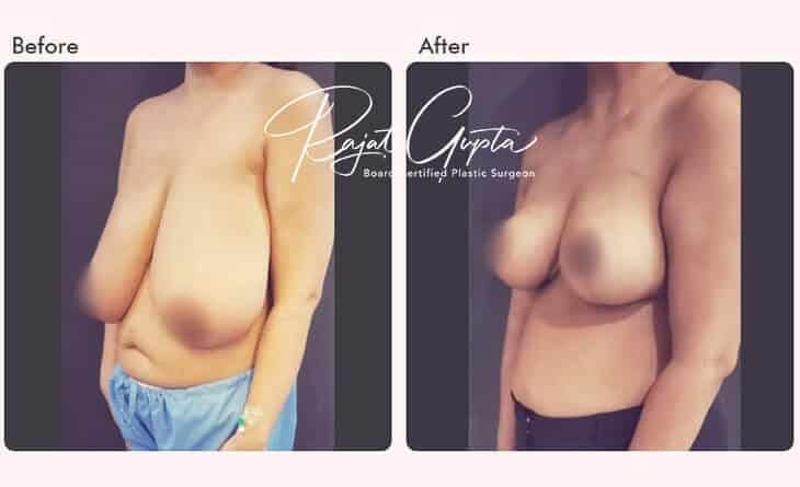 Breast Reduction Surgery Before and After- RG Flap Technique Surgery - Dr Rajat Gupta - Plastic surgery specialist Delhi - RG Aesthetics Breast Reduction Surgery Before and After- RG Flap Technique Surgery - Dr Rajat Gupta - Plastic surgery specialist Delhi - RG Aesthetics