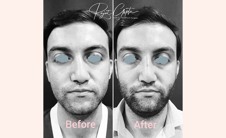 Nose Job Surgery Before And After- Dr Rajat Gupta- Plastic Surgeon in Delhi nose job surgery before and after
