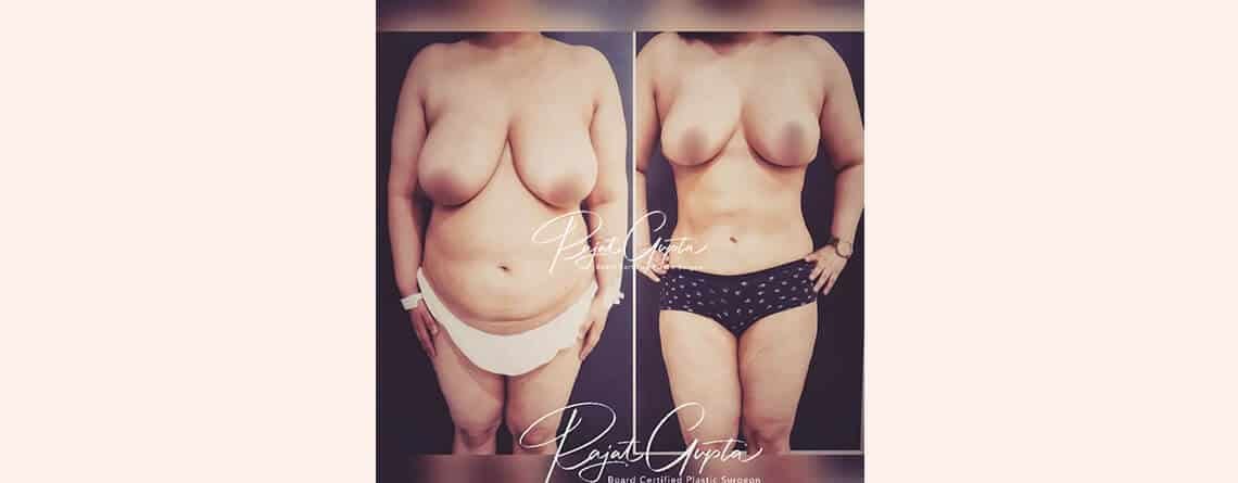 Breast Reduction Surgery Before and After