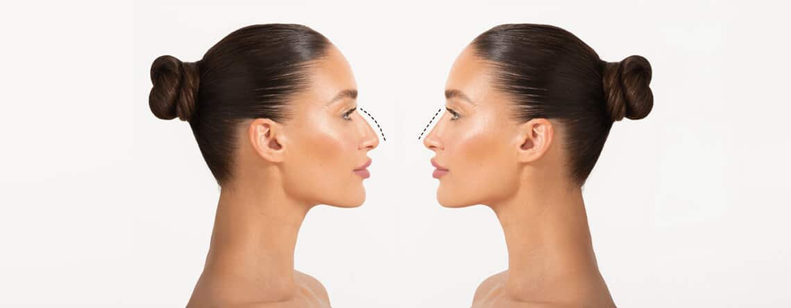 Rhinoplasty Surgery in Delhi