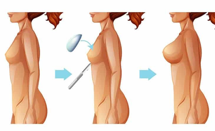 Is Breast Reconstruction Surgery Worth It - Dr Rajat Gupta - Plastic Surgeon in Delhi - RG Aesthetics Is Breast Reconstruction Surgery Worth It - Dr Rajat Gupta - Plastic Surgeon in Delhi - RG Aesthetics