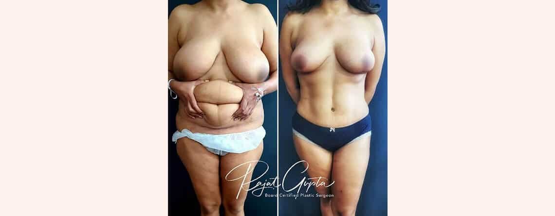 Virtual Consultations for Tummy Tuck Surgery - Tummy Tuck Results - Dr Rajat Gupta - Plastic Surgeon in India