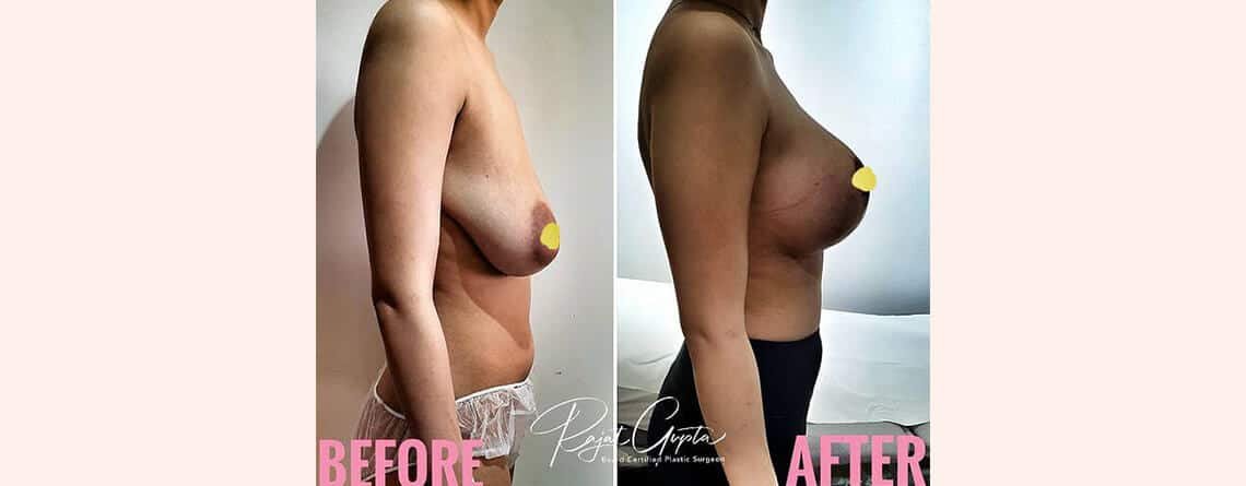 Breast Lift in Delhi