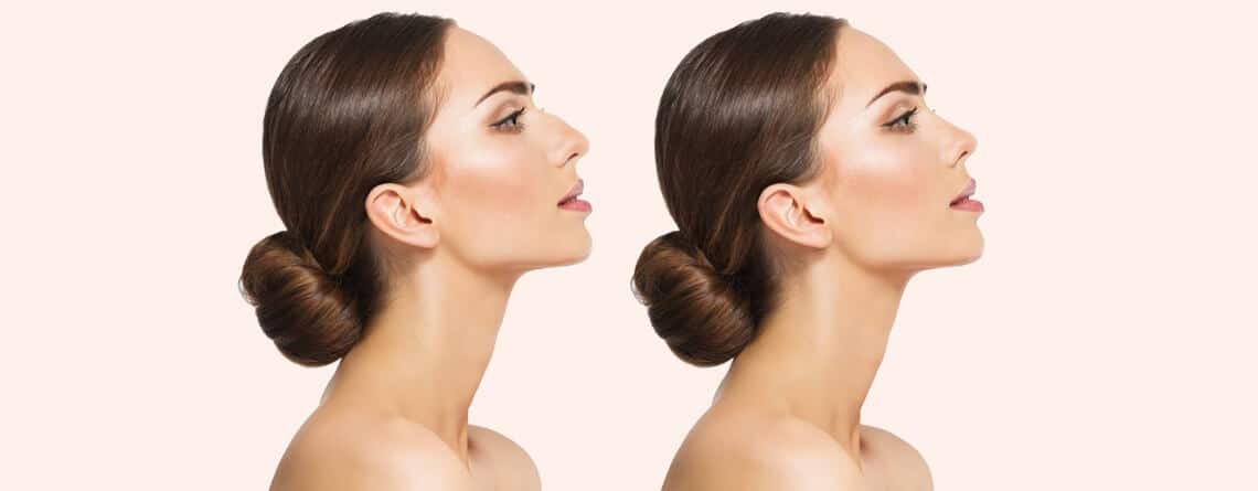 How Long Does a Nose Job Take to Heal - Rhinoplasty Surgery in Delhi