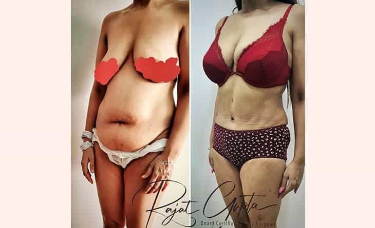 Liposuction Surgery Before and After - Liposuction Surgery Cost in Delhi - Dr Rajat Gupta Liposuction Surgery Before and After - Liposuction Surgery Cost in Delhi - Dr Rajat Gupta