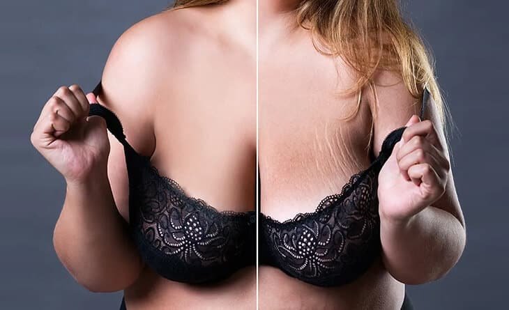 Breast Changes After Pregnancy - Dr Rajat Gupta Breast Changes After Pregnancy