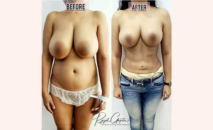 Breast Reduction Surgery Before and after result Breast Reduction Surgery Before and after