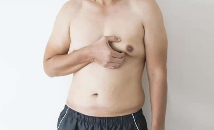 Gynecomastia Surgery- Causes & Treatment - Dr Rajat Gupta Gynecomastia Surgery