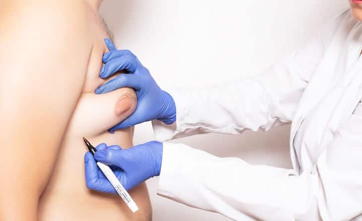 Gynecomastia surgery procedure - Dr Rajat Gupta Gynecomastia surgery procedure - Dr Rajat Gupta