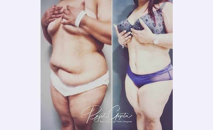 Tummy Tuck Surgery (Abdominoplasty) for Loose Skin - Dr Rajat Gupta Tummy Tuck Surgery (Abdominoplasty) for Loose Skin