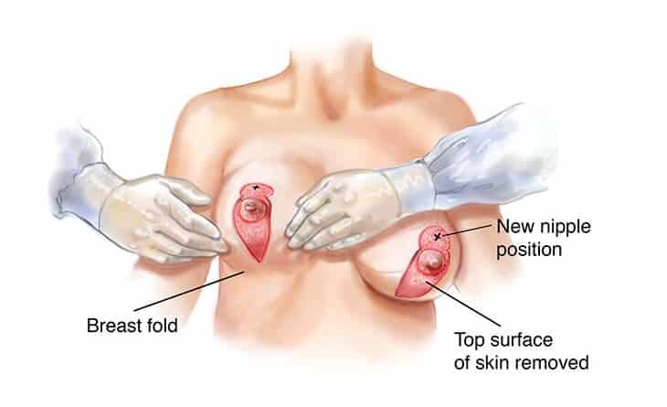 Breast Lift Surgery Techniques - Dr Rajat Gupta Breast Lift Surgery Techniques