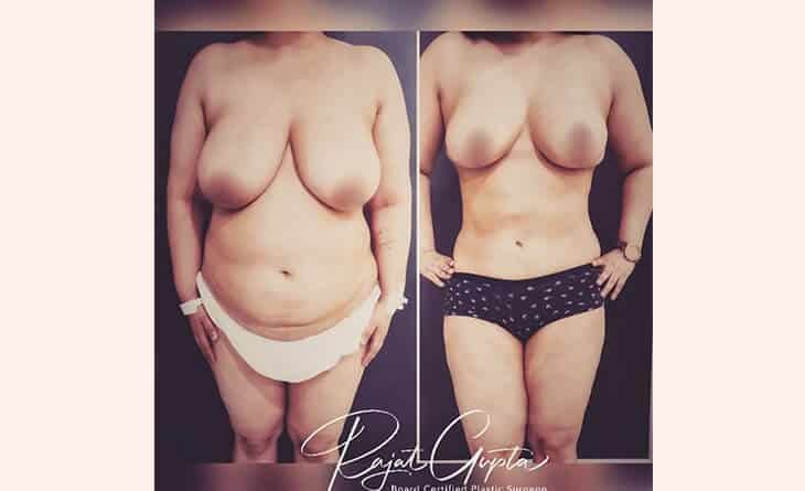 Liposuction Surgery Before After Results - Dr Rajat Gupta Liposuction Surgery Before After Results - liposuction surgery in Delhi