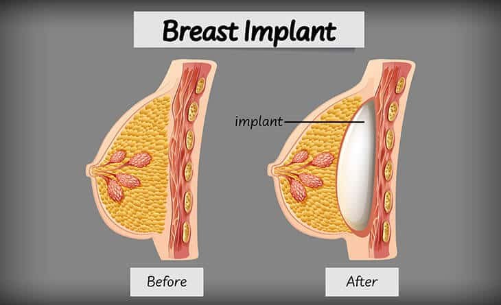 What Is Breast Augmentation Surgery - Dr Rajat Gupta - RG Aesthetics Breast Augmentation in Delhi